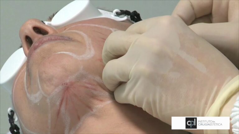 Costo Promedio de la Reducci&oacute;n de Papada con Radiofrecuencia