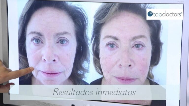 Beneficios de los Hilos Tensores para el Rostro