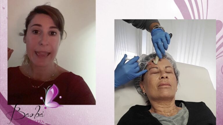 Testimonios Impactantes sobre Tratamientos de B&oacute;tox