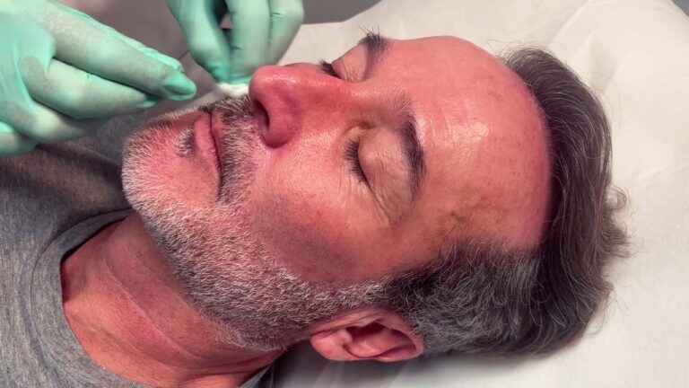 Resultados Visibles de Microagujas en Ojeras: Comparativa Antes y Despu&eacute;s