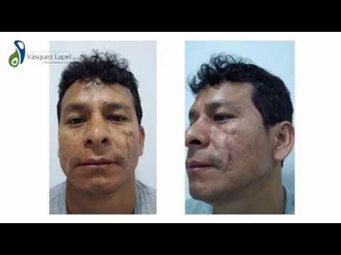 Testimonios Efectivos sobre la Terapia L&aacute;ser para el Acn&eacute;