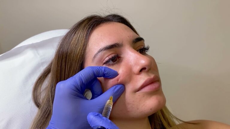 Duraci&oacute;n de Resultados en Tratamientos para Ojeras