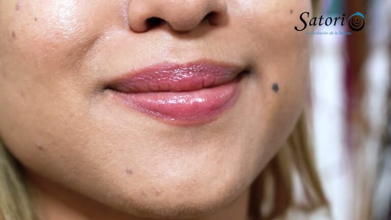 Opiniones sobre Rellenos D&eacute;rmicos en Medicina Est&eacute;tica