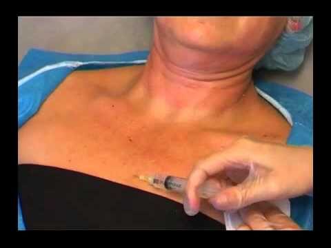 Consejos Esenciales para Mantener Resultados de Lifting de Cuello