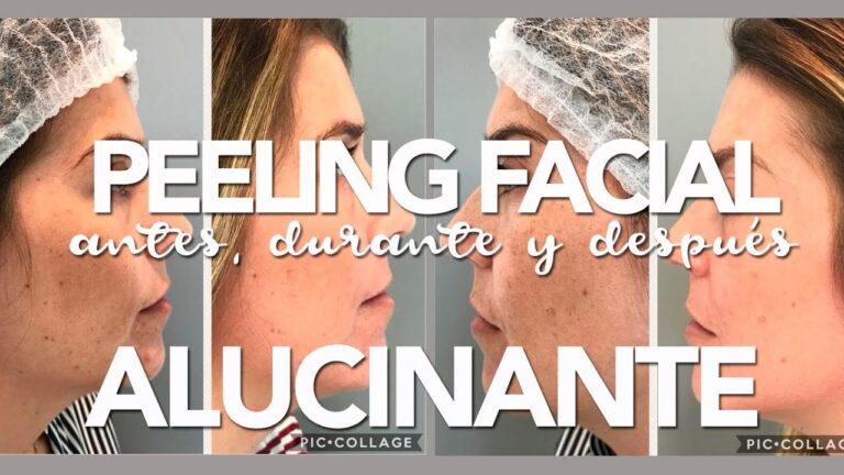 Resultados Impactantes de Peelings Qu&iacute;micos para Ojeras