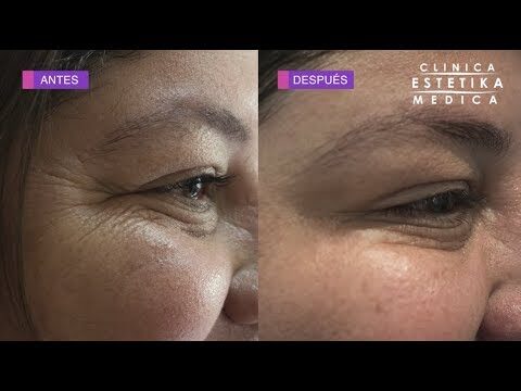 Resultados Esperados del B&oacute;tox en el Rostro: Todo lo que Debes Saber